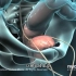 大多数男性必经之路，前列腺增生电切手术过程，3D演示。。