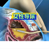 女性导尿