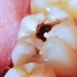【口腔知识科普】第一视角看医生补蛀牙，牙齿已经被掏空