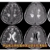 颅脑MRI病变：一例多发性硬化病例分享，典型征象解析！