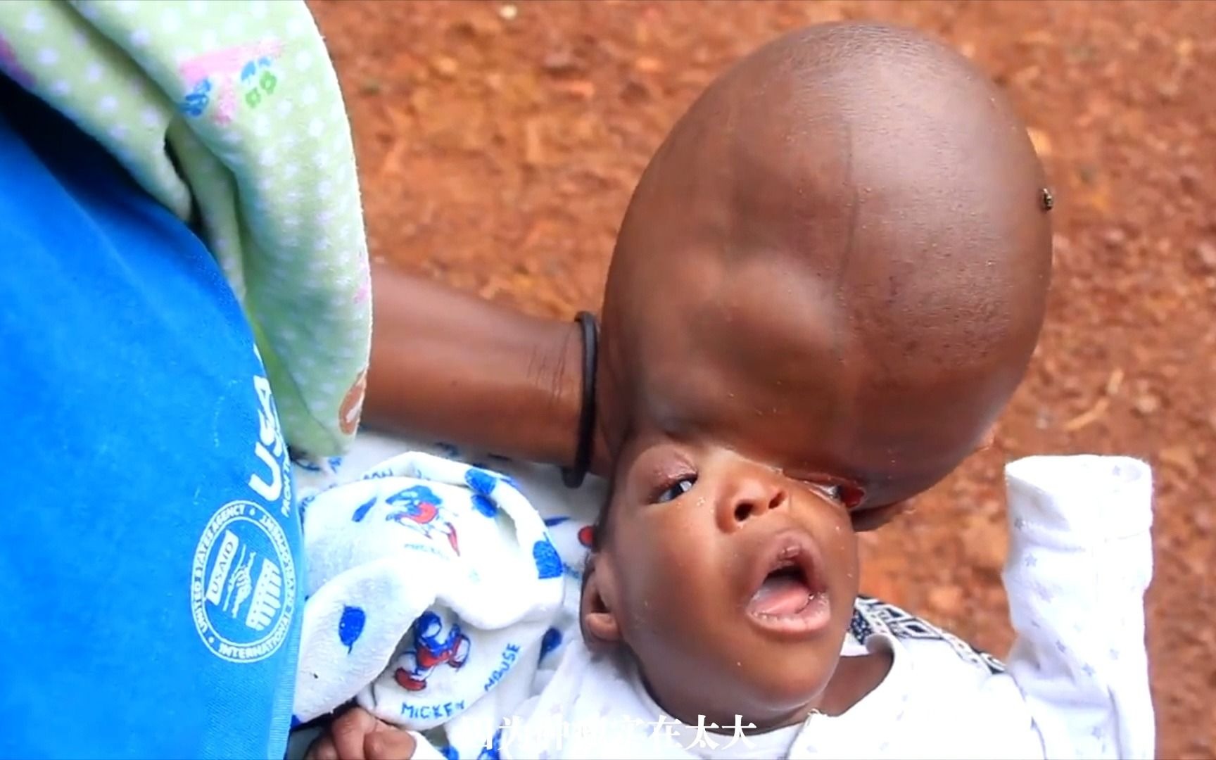 非洲的“外星婴儿”，一个伟大母亲的求医之路，母爱的伟大让人震撼