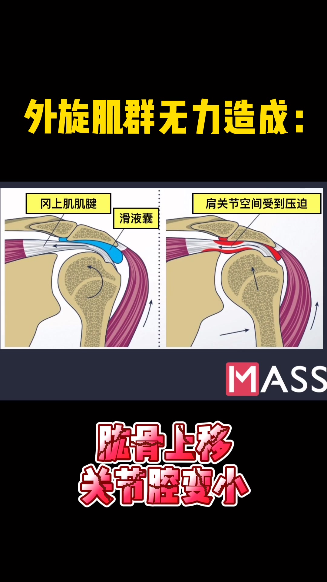 【肩关节弹响的改善：上集，无效你揍我】