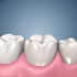 动画演示下种植牙的过程~缺牙的小可爱可以看下哈