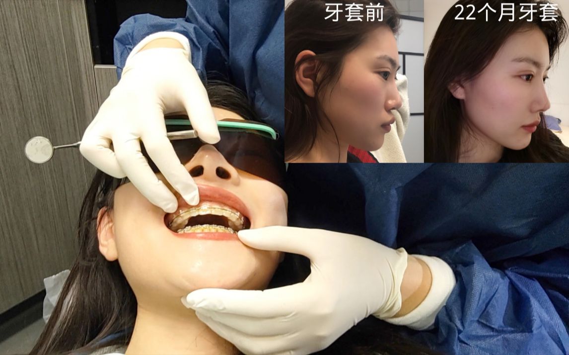 钢牙妹摘牙套全过程实录｜是重生的感觉｜牙齿美白｜牙齿补齐｜22个月的牙齿矫正
