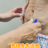6个月前吸脂失败，早知腹部整形能一次性都解决，何苦这么折腾