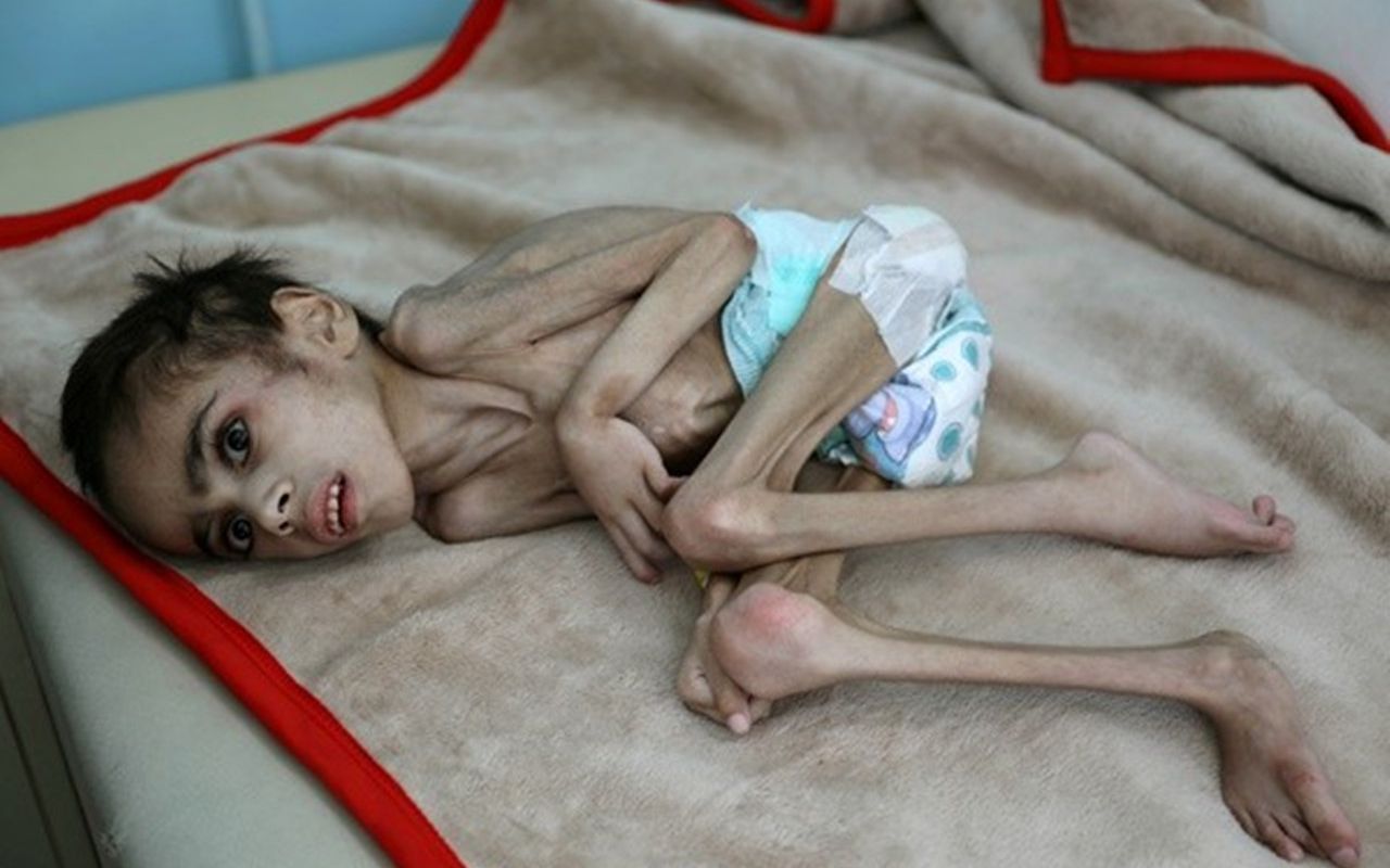 也门7岁”骷髅男童“严重营养不良 瘦到只剩骨头体重仅7公斤