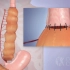 这手术味很大吧，用大肠代替食管治疗食管闭锁，3D演示。。