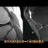 半月板撕裂在MRI上什么表现？放射科医生分享典型病例