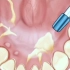 看❗牙结石轻松去除，超声波洁牙，不伤牙，建议您半年至一年洗一次哦！#洗牙 #超声波洁牙 #雅美佳口腔连锁