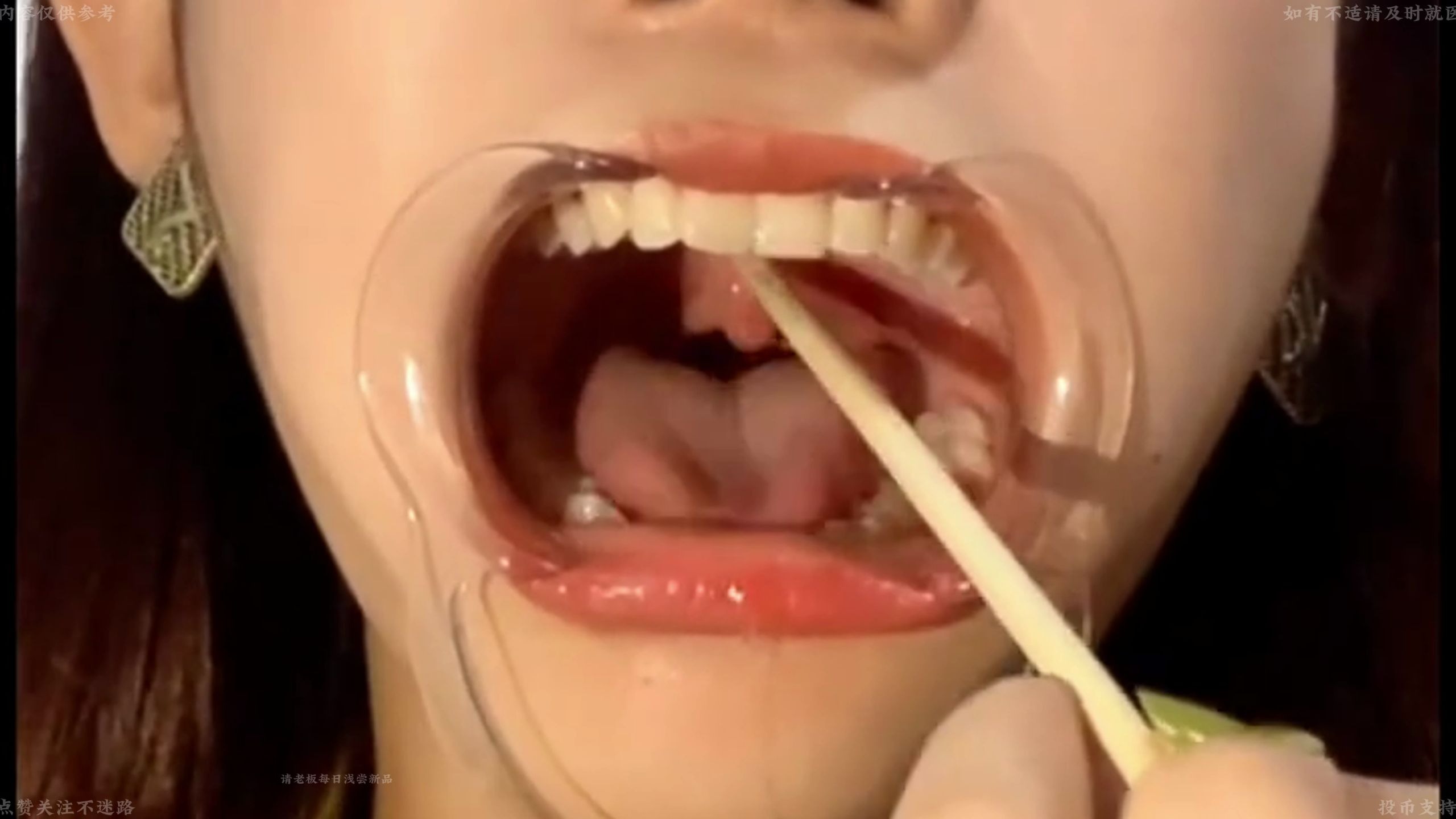 【口腔检查35】下雨天好干涩的嘴巴~