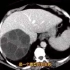 25岁男性，上腹部不适，腹部CT发现肝脏占位，诊断什么？