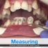【牙齿矫正】金属托槽矫正/附带矫正正确的刷牙姿势