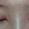 做完双眼皮手术感觉失败了？全切开眼角后眼头增生了，四个月可以恢复成什么样？割双眼皮后真的可以翘睫和改善倒睫吗