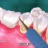 超声波洗牙过程，3D演示。。