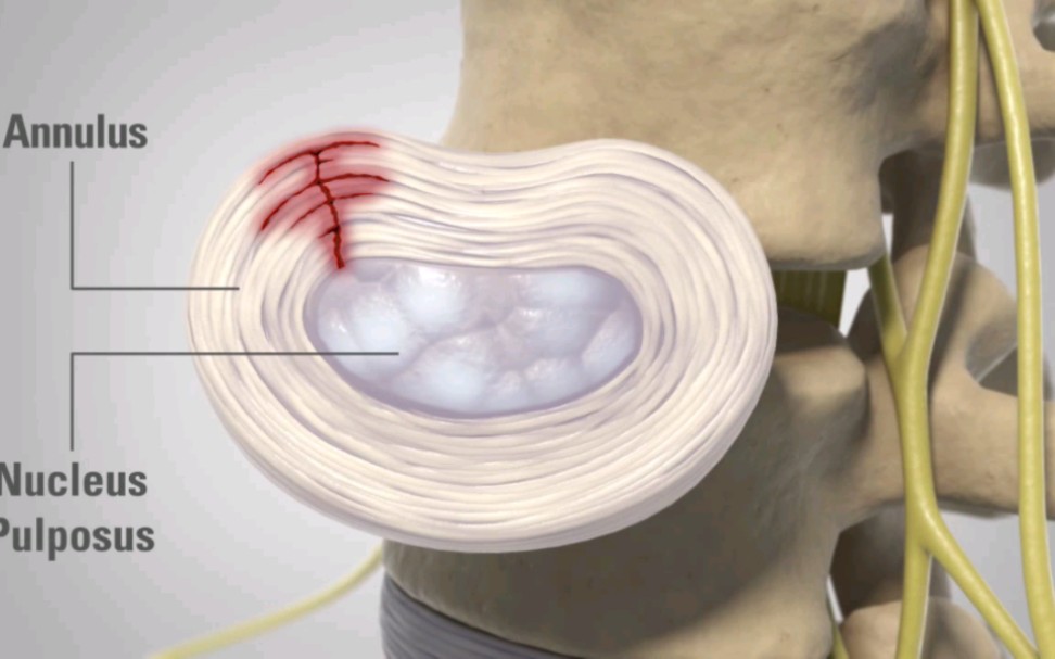 腰椎间盘突出发病原因，怎么治疗，3D演示。。