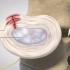 腰椎间盘突出发病原因，怎么治疗，3D演示。。