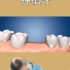 为什么牙医都推荐做种植牙？一颗种植牙可以用一辈子吗？