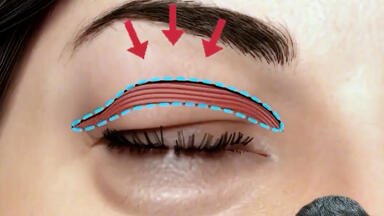 <em class="keyword">双眼皮修复宽</em>改窄科普解析