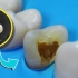【高清】一个前磨牙的根管治疗+纤维状加强+高嵌体修复的过程（本视频是将离体牙固定于模型上操作，清晰而真实）