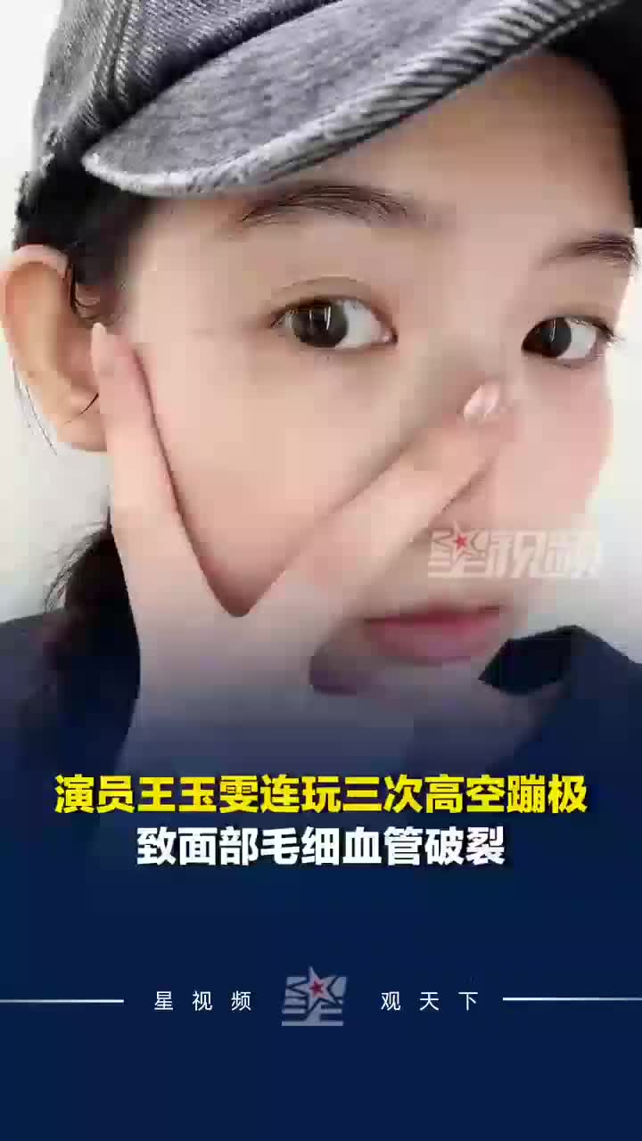 演员王玉雯连玩3次高空蹦极致面部毛细血管破裂，大方晒照发声