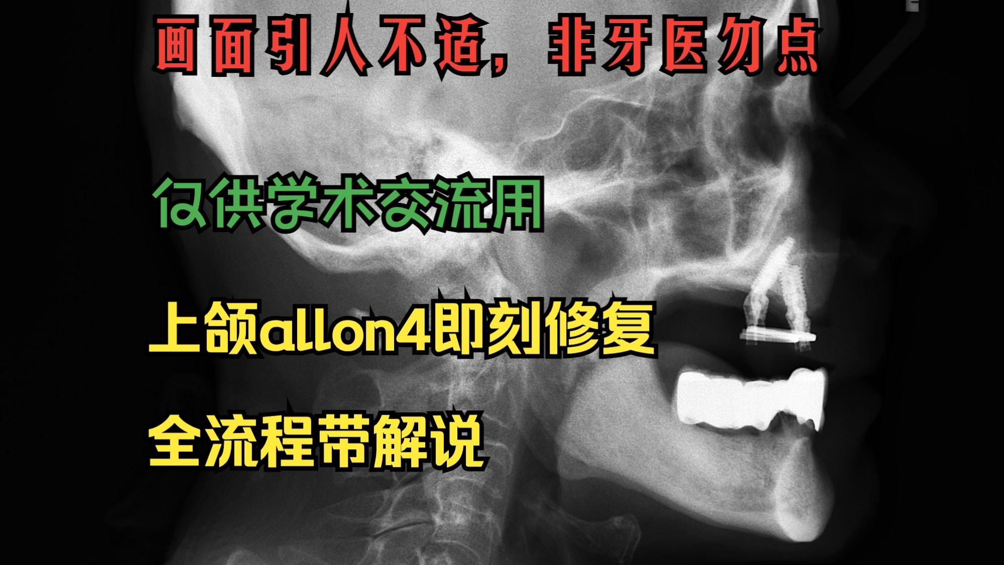 上半口allon4即刻修复