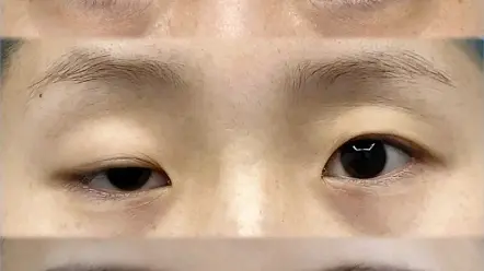 上睑下垂也就是我们常说的提肌无力矫正