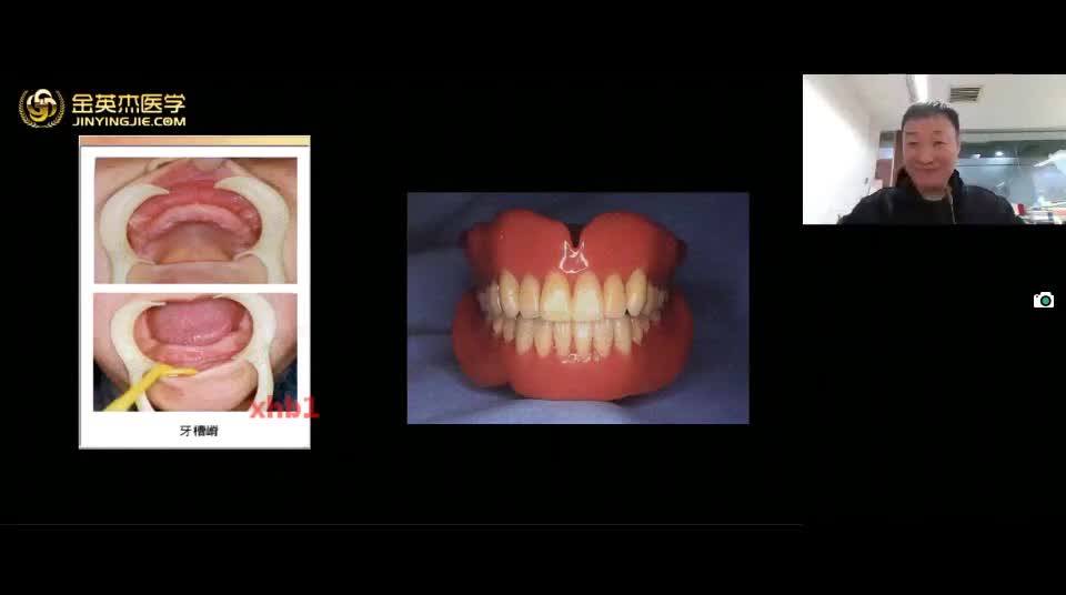 30.口修（八）第四单元 牙列缺失（2）