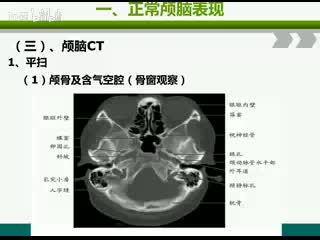 影诊-中枢系统正常影像表现（CT、MR)