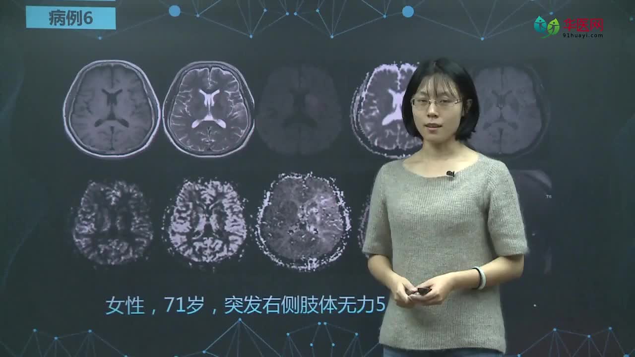 缺血性脑卒中的影像读片（下）