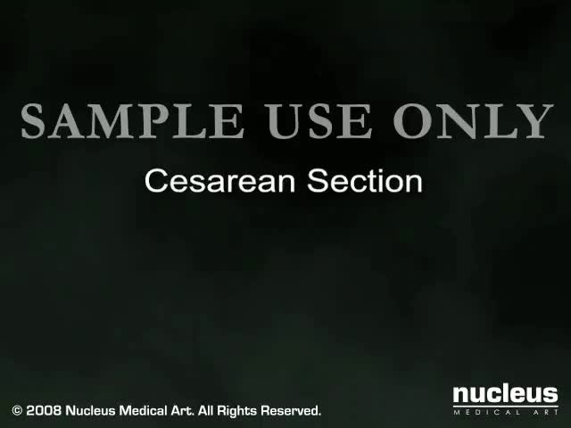 剖腹产(剖腹产) 8-C-section (Cesarean Delivery)