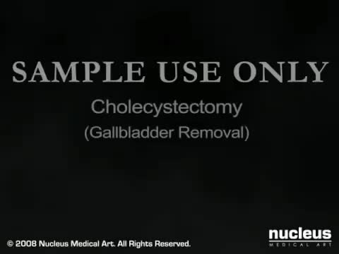 胆囊手术治疗胆结石 101-Gallbladder Surgery for Gallstones