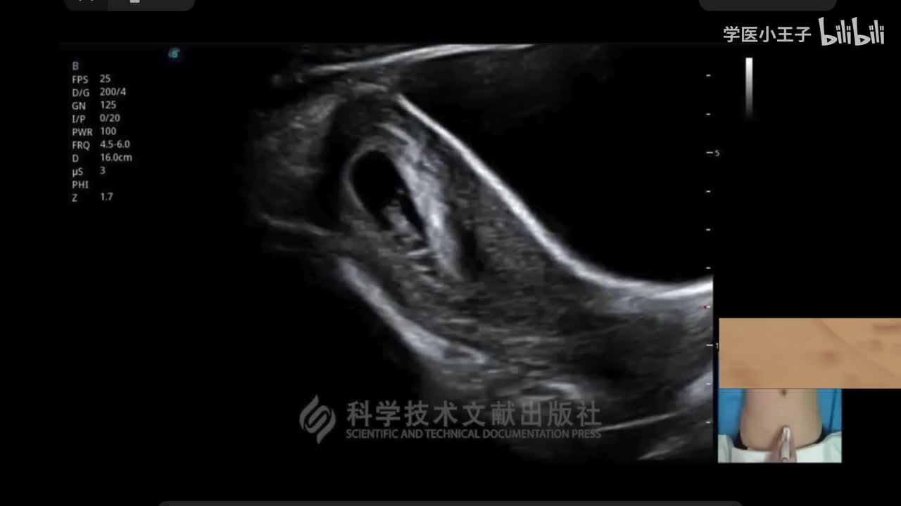 超声小白教程-产科胎儿超声扫查
