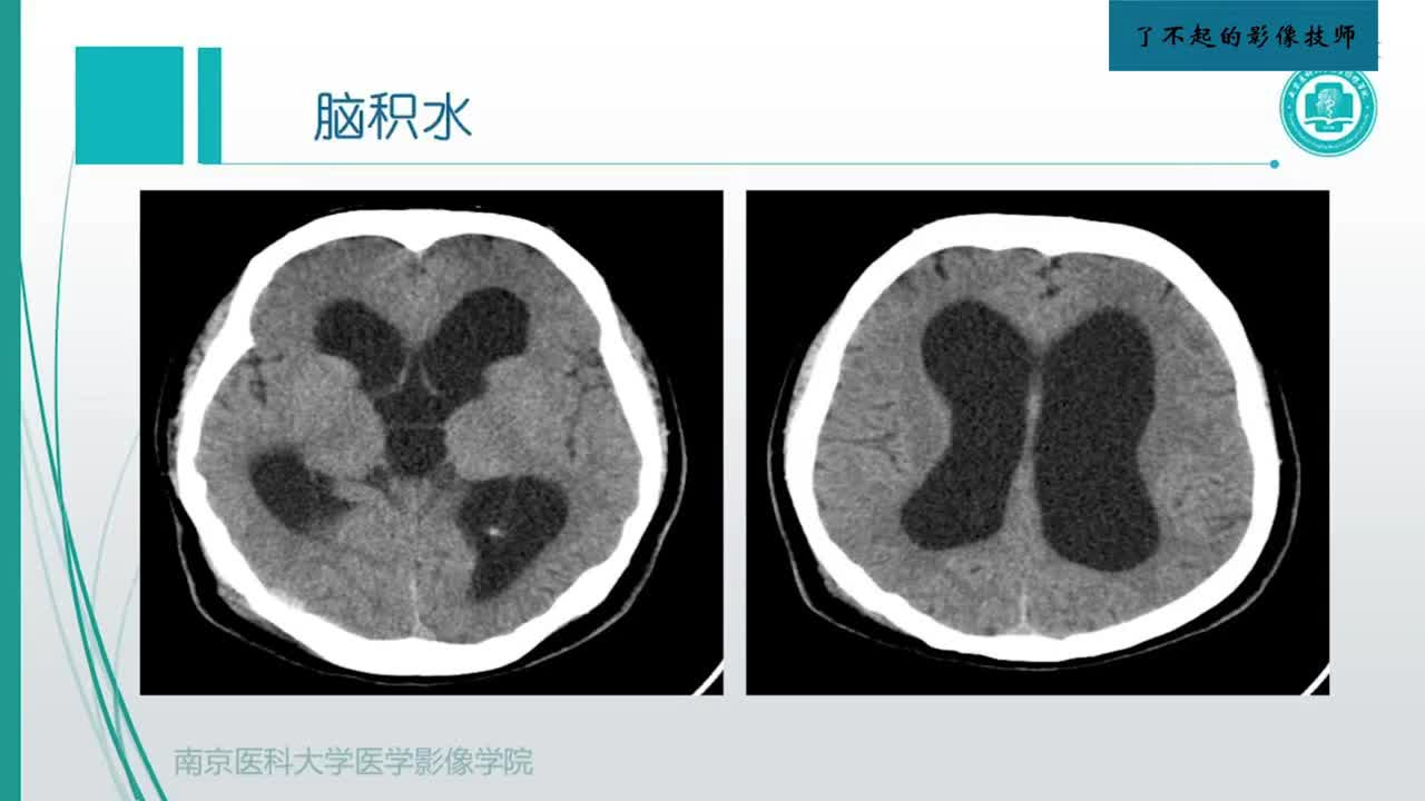 2.1 中枢影像概述2