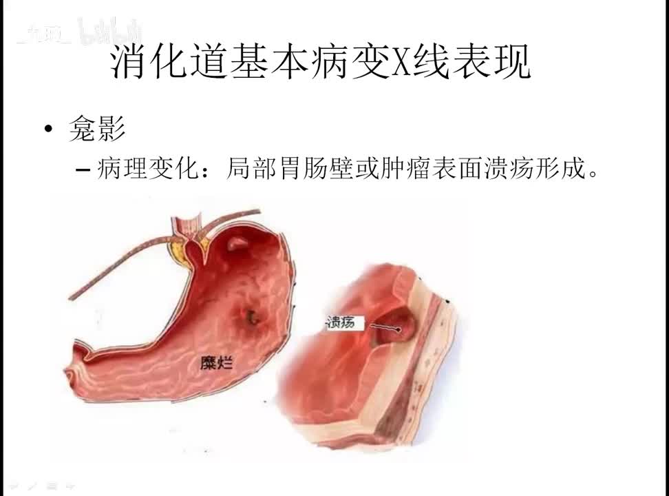 23 消化-3-消化道异常及食道