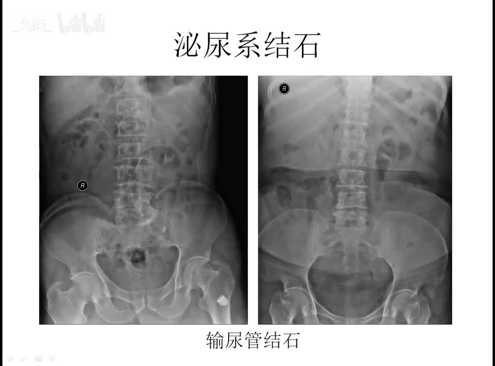 31 泌尿生殖-3-泌尿结石、结核、肾癌