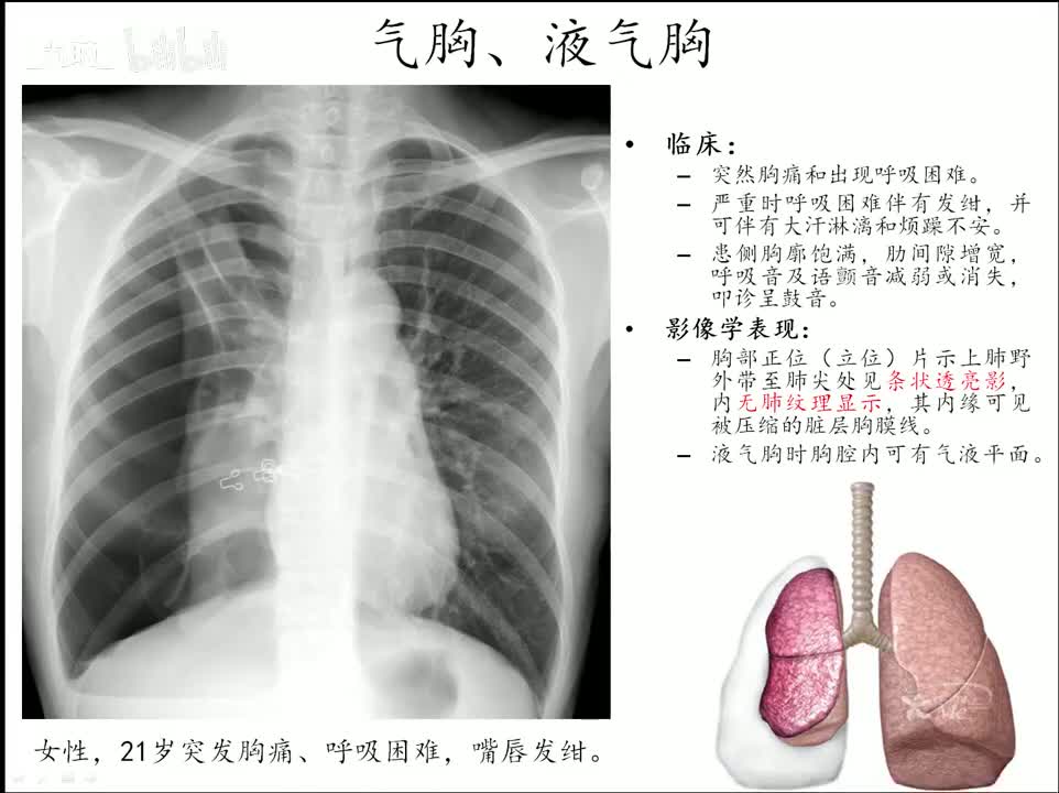 14 呼吸-4-基本病变3及疾病诊断1