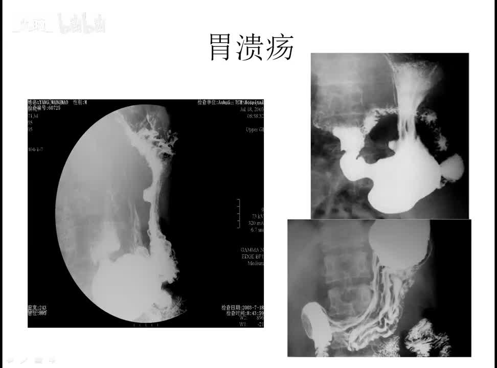 24 消化-4-消化道疾病