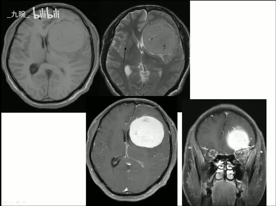 10 中枢-5-垂体瘤