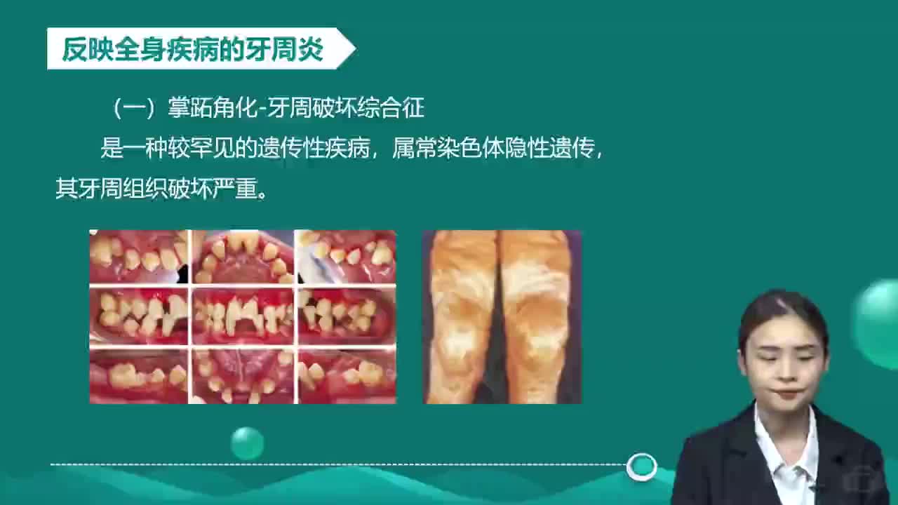 04-第1章 口腔内科学 第2讲 牙周疾病2