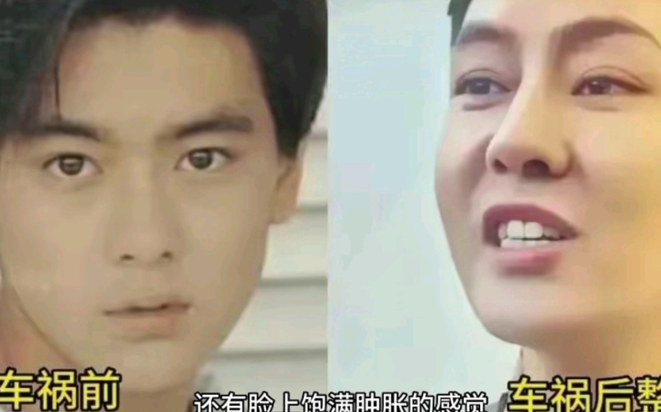 林志颖车祸后,整容判若两人,差点没认出来