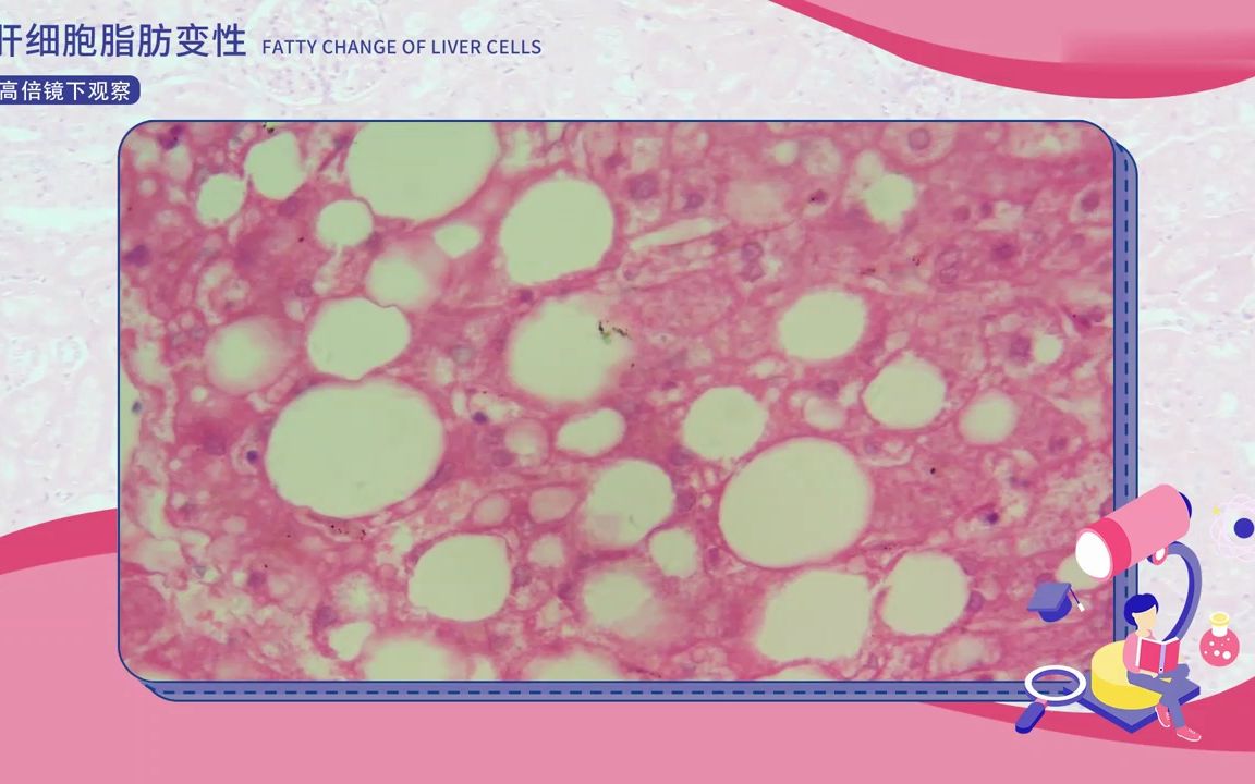 [图][2.2.5] 微观探病 肝细胞脂肪变性
