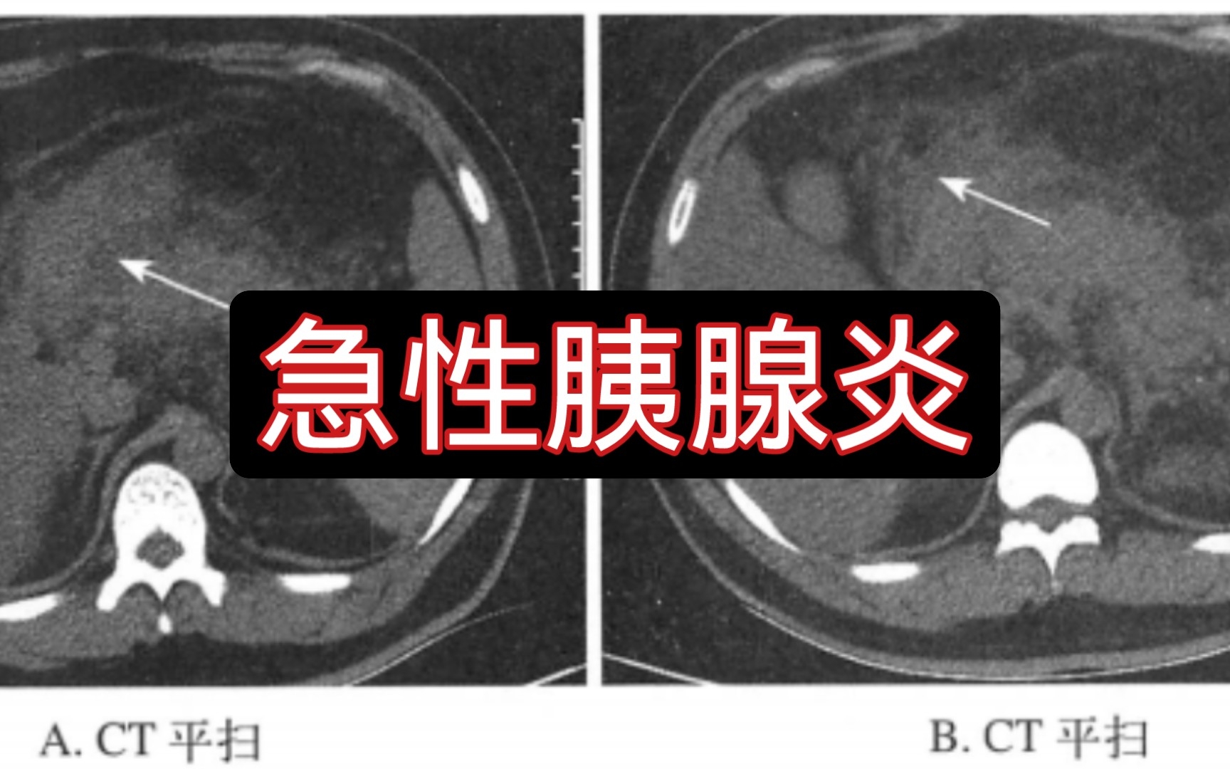 [图]【医学影像】跟我一起刷病例 | 急性胰腺炎