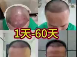 Tải video: 植发第1天到60天的变化过程：植发5000多单位两个月恢复，让我解决一大心结！