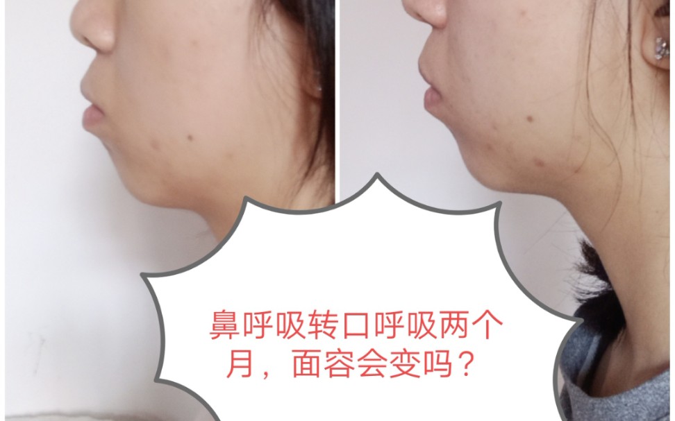 亲测换头成年人改用鼻呼吸后口呼吸面容可以改善吗亲身测试改善凸嘴