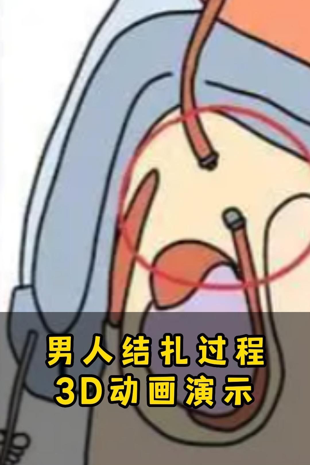 男人结扎过程演示哔哩哔哩bilibili