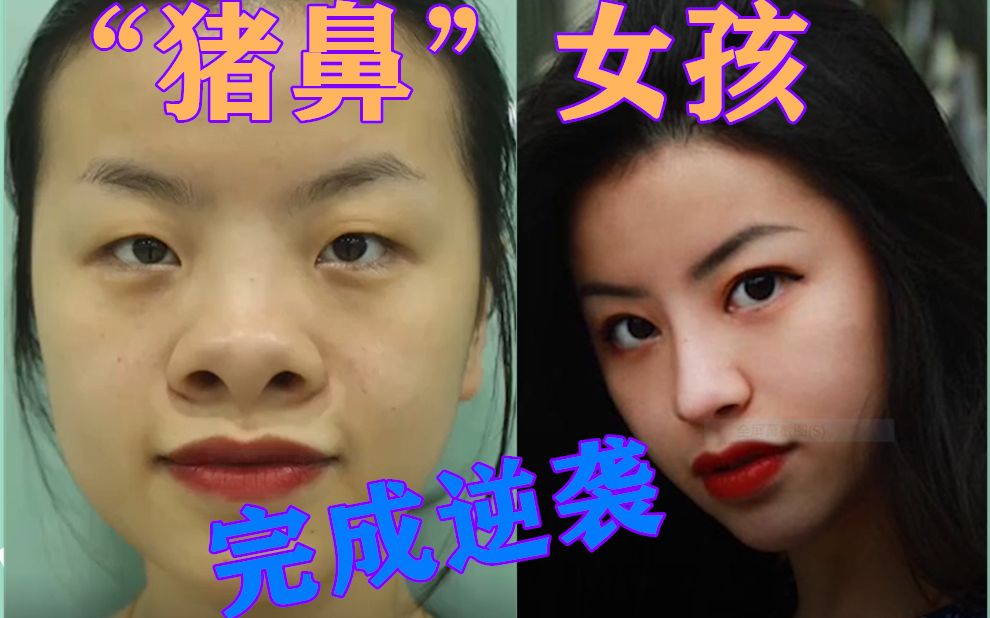 被人嘲笑二十几年的猪鼻子女孩,完成人生逆袭