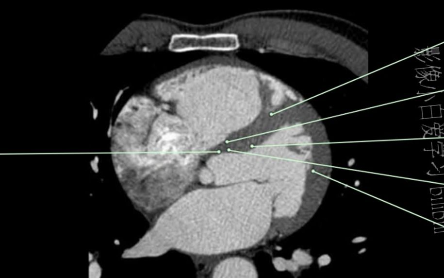 8.心血管影像解剖图谱心脏传导系统CT解剖哔哩哔哩bilibili