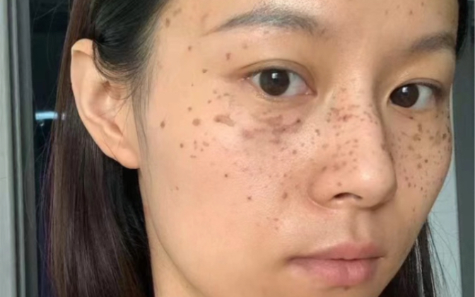 遗传斑好了两年多了