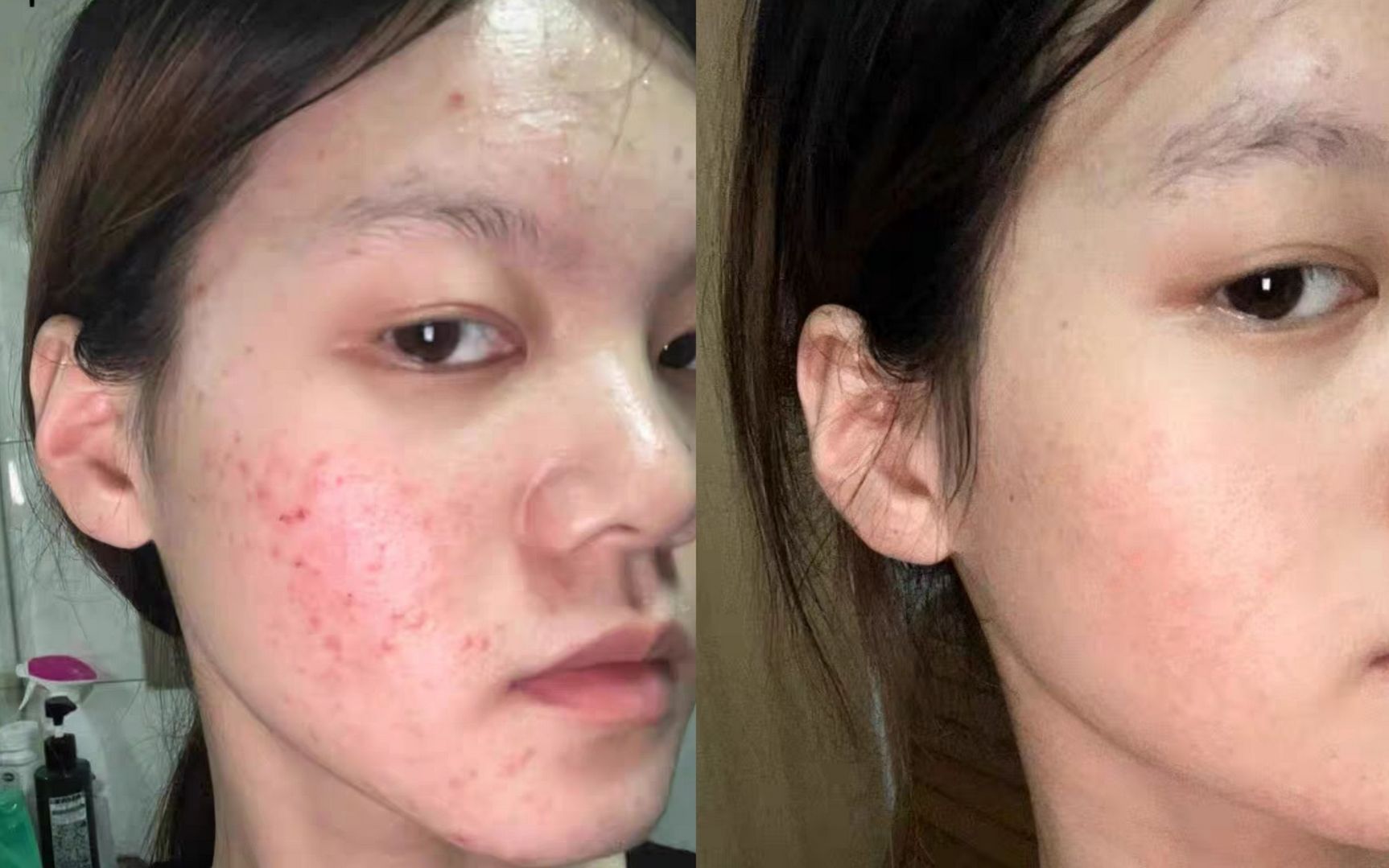 为什么下巴总是长痘痘?背后的原因你可能不知道!