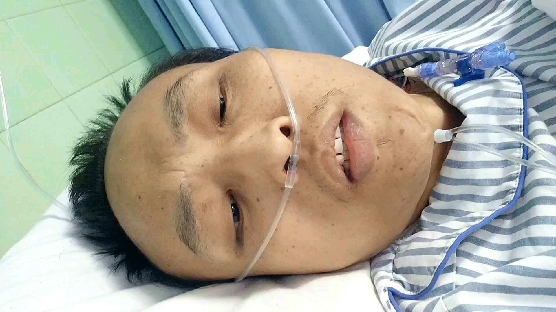 肝硬化低蛋白重度贫血拍视频挣点儿医药费